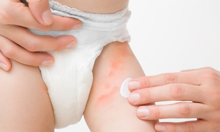 5 Foods That Are Secretly Causing Diaper Rash