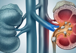 Kidney stones - self-care