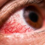Conjunctivitis cases surge after heavy rains: What precautions should we take to prevent redness, blurry vision and eye discomfort?