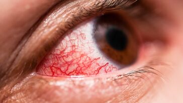 Conjunctivitis cases surge after heavy rains: What precautions should we take to prevent redness, blurry vision and eye discomfort?