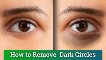 dark circles home remedies dark circles natural treatment home remedies home remedies for dark circles treat dark circles naturally